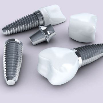 6 Reasons To Consider Dental Implants
