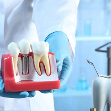 The Impact of Dental Implants on Overall Oral Health and Wellness