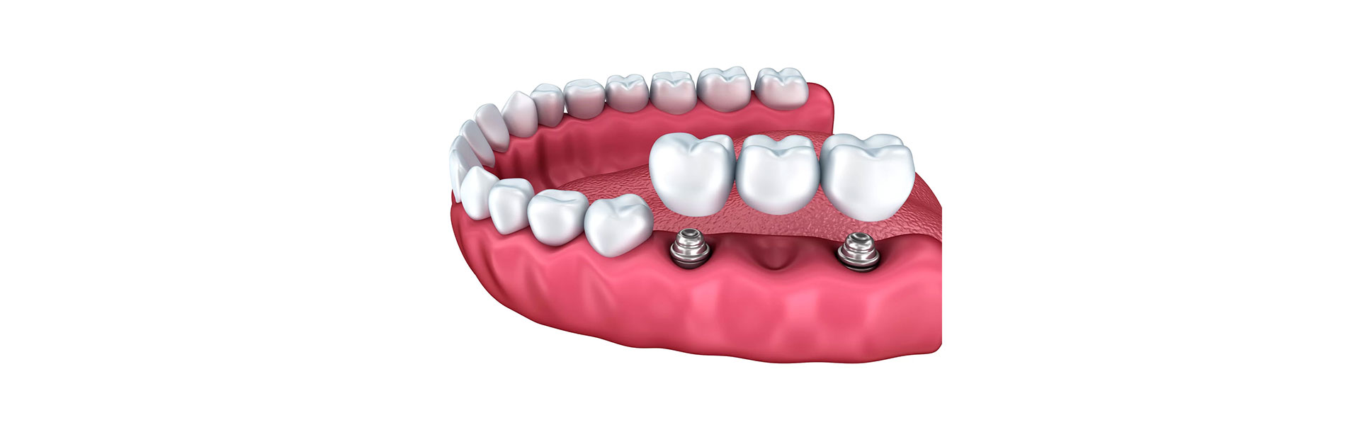 Implant Crowns in Beverly, MA