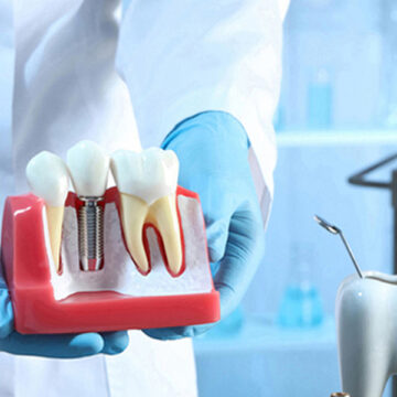 Rediscover Your Best Smile with Implant Crowns: Uses and Benefits Explained