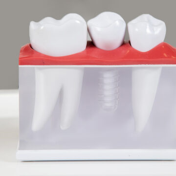 How to Take Good Care of Dental Implants After Surgery?