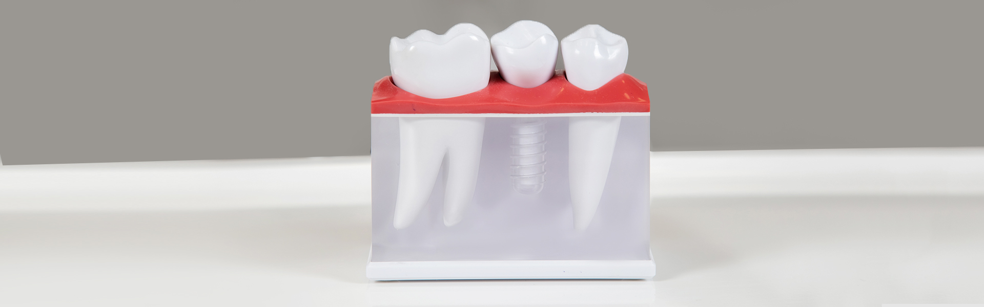 How to Take Good Care of Dental Implants After Surgery? 