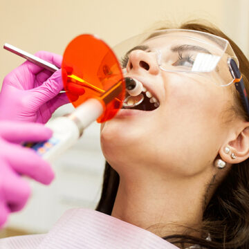 How Long Does Tooth Restoration Last?