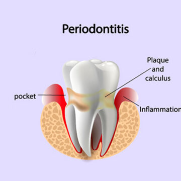 What Are the Early Symptoms of Periodontal Disease?
