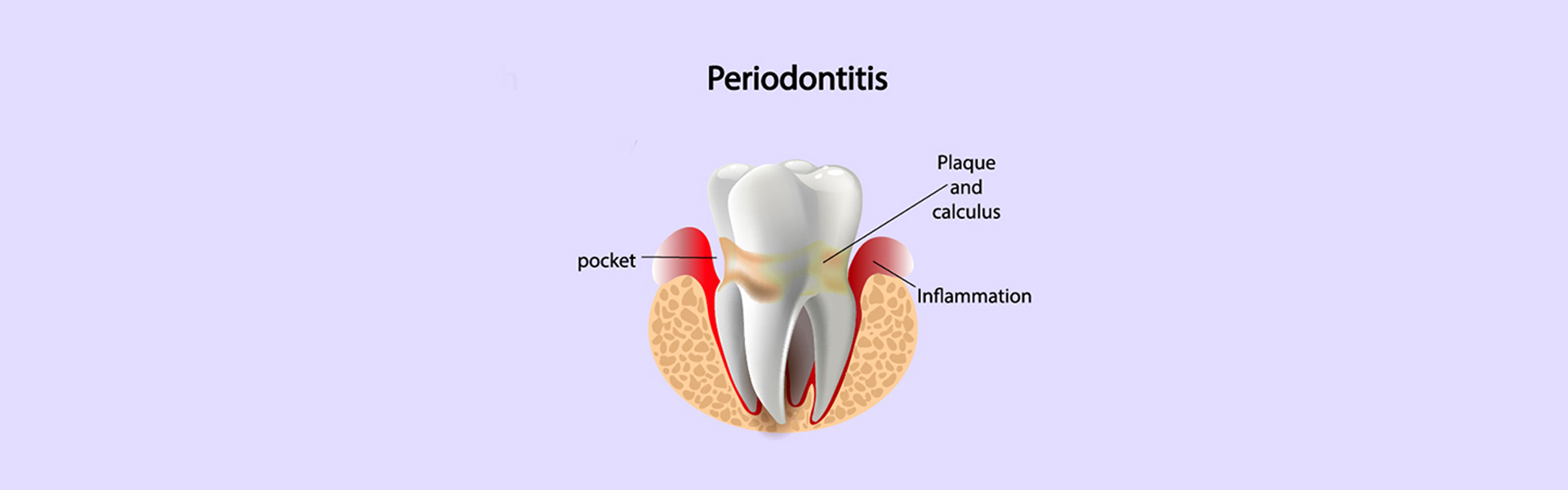 What Are the Early Symptoms of Periodontal Disease?
