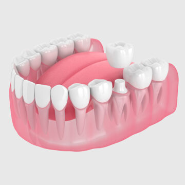 Why Dental Crowns Are Essential for Post-Root Canal Care
