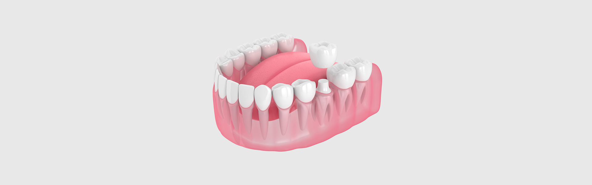 Why Dental Crowns Are Essential for Post-Root Canal Care