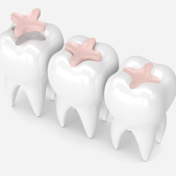 Colored Fillings: A Durable Solution for Cracked Teeth