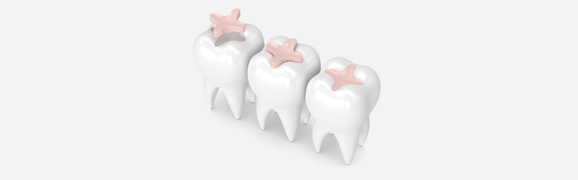 Colored Fillings: A Durable Solution for Cracked Teeth